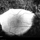 Macula Spared Advanced Retinitis Pigmentosa 5